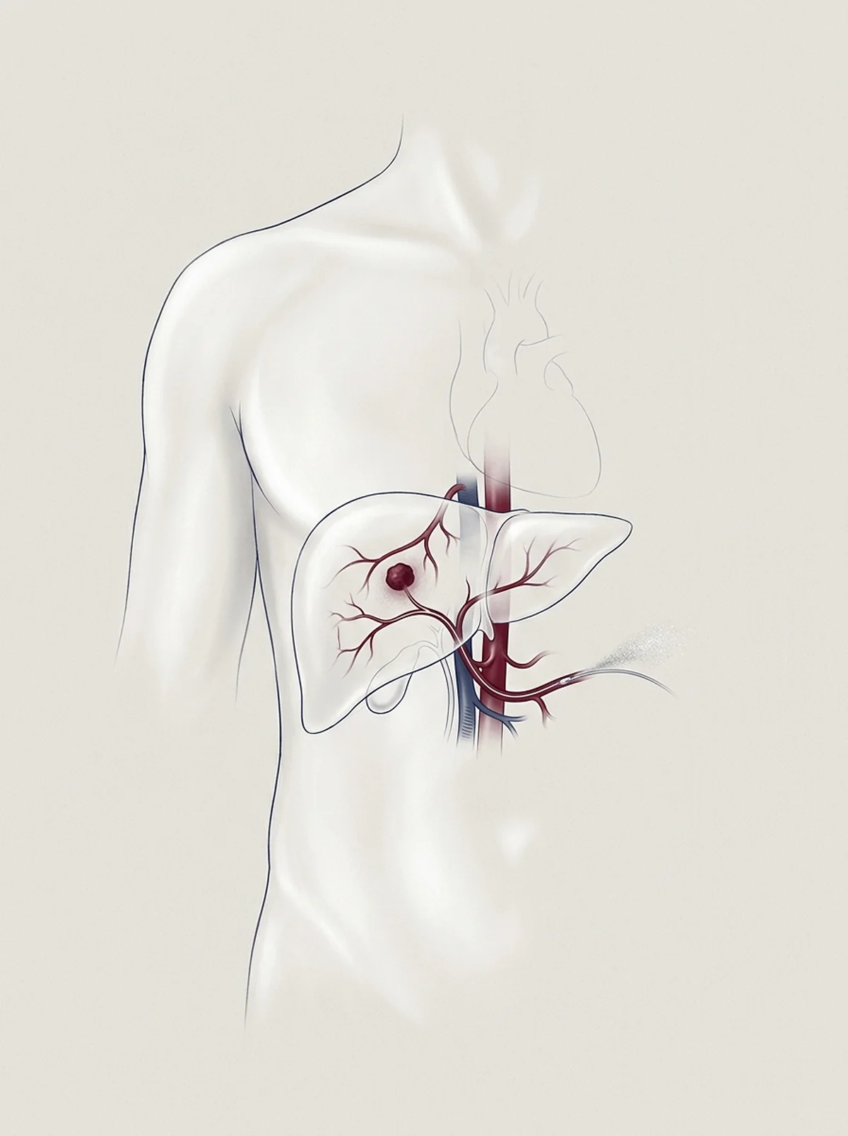 Ilustração: tronco translúcido com o fígado em destaque, um nódulo escuro e um cateter que chega pela artéria até ele.